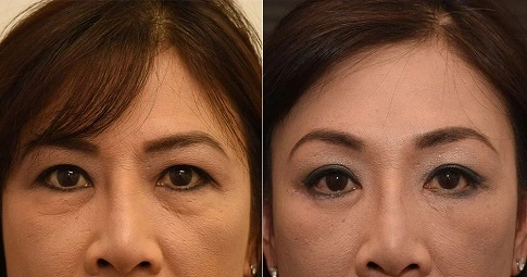 Brow Lift Surgery Before and After