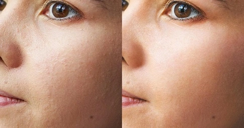 Large Pores Treatment before and after