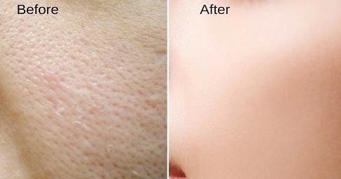 Large Pores Treatment before and after