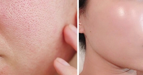 Large Pores Treatment before and after