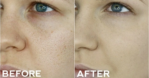 Large Pores Treatment before and after
