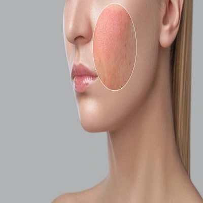 Large Pores Treatment in Dubai