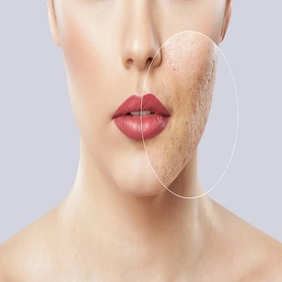 Large Pores Treatment in Dubai