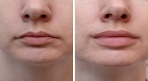 Lip Filler Injection Cost in Dubai