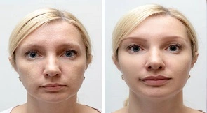 Lip Filler Injection Cost in Dubai