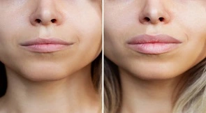 Lip Filler Injection Cost in Dubai
