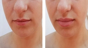 Lip Filler Injection Cost in Dubai