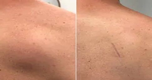 Lipoma treatment before and after