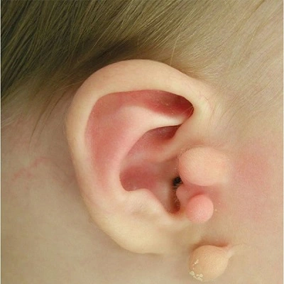 Preauricular Tag Removal in Dubai