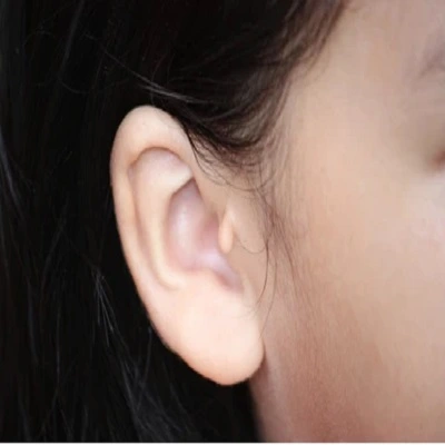 Preauricular Tag Removal in Dubai