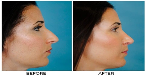Septoplasty and turbinate reduction Before and After