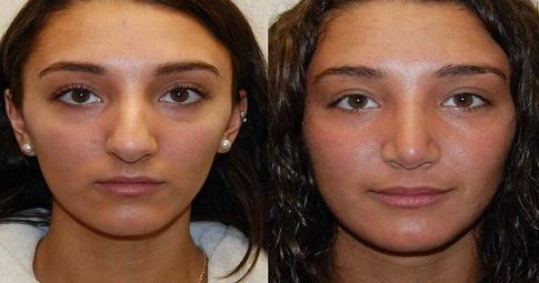Septoplasty and turbinate reduction before and after