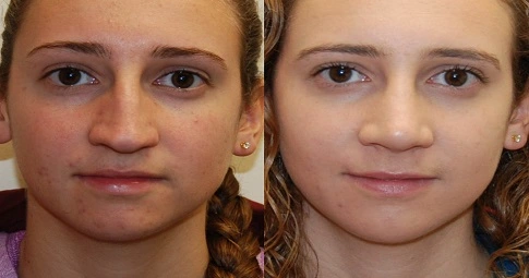 Septoplasty and turbinate reduction before and after