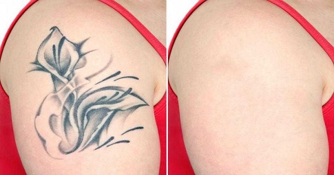 Tattoo Removal before and after