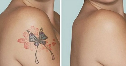 Tattoo Removal before and after