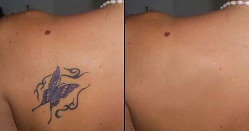 Tattoo Removal before and after