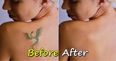Tattoo Removal Before and After