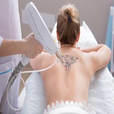 Tattoo Removal in Dubai