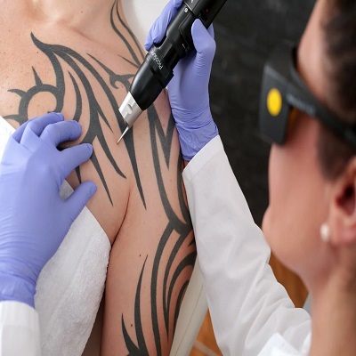 Tattoo removal using PicoSure device