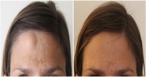 Lipoma treatment before and after