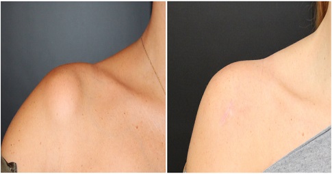 Lipoma treatment before and after