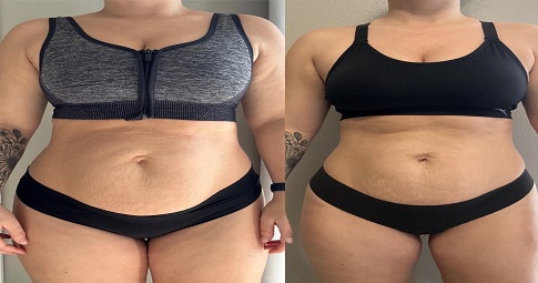 Mini Tummy Tuck before and after