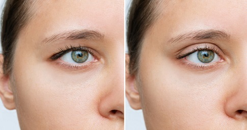 Blepharoplasty​ Surgery before and after