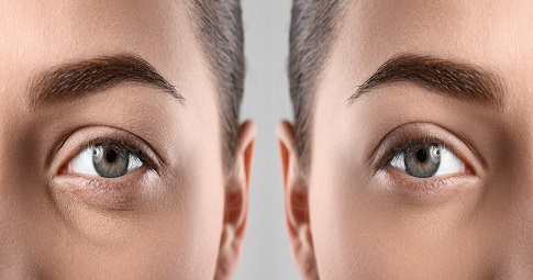 Blepharoplasty​ Surgery before and after