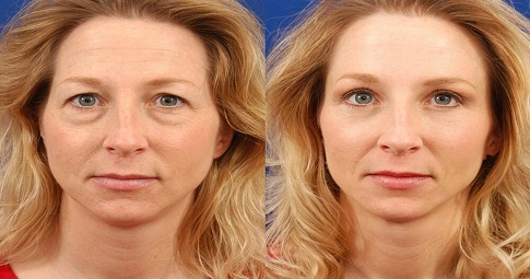 Blepharoplasty​ Surgery before and after
