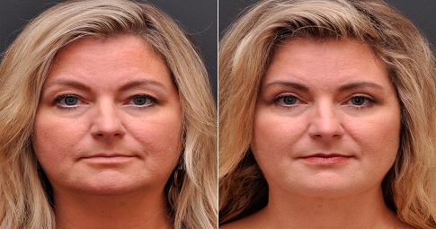 Blepharoplasty​ Surgery before and after