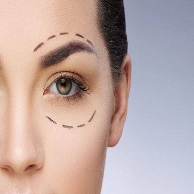 Blepharoplasty​ Surgery in Dubai