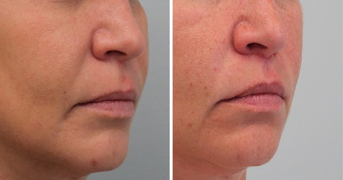 Bullhorn Lip Lift before and after