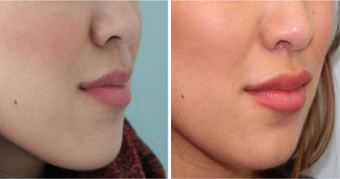 Bullhorn Lip Lift before and after