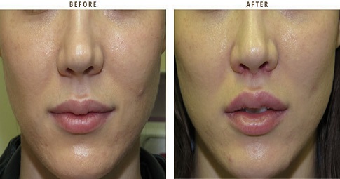 Bullhorn Lip Lift before and after
