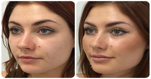 Cheek Augmentation before and after