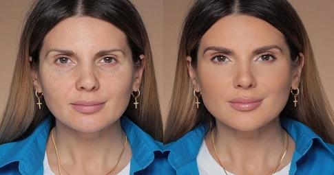 Cheek Augmentation before and after
