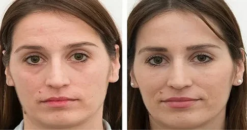 Cheek Augmentation before and after