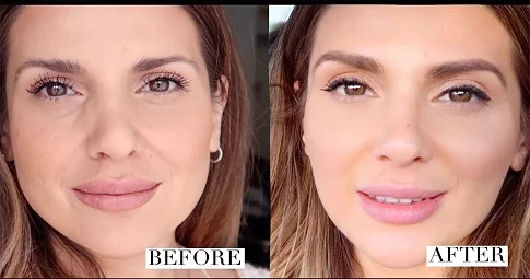 Cheek Augmentation before and after