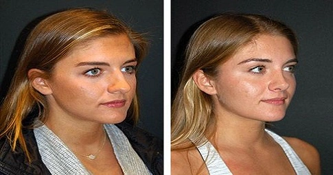 Closed Rhinoplasty before and after