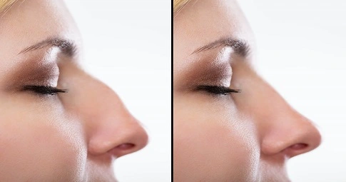 Closed Rhinoplasty before and after