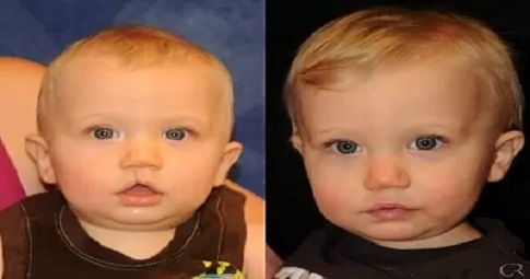 Congenital Anomalies before and after