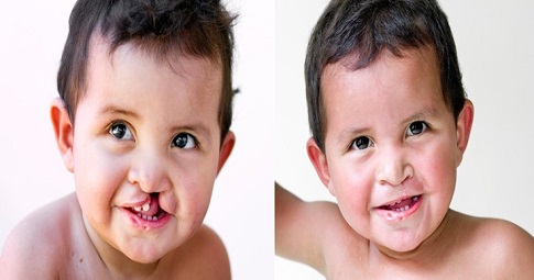 Congenital Anomalies before and after