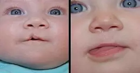 Congenital Anomalies before and after
