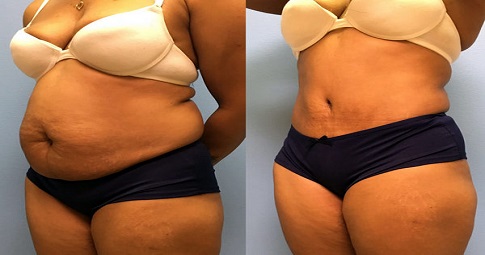 Laser Lipolysis Treatment before and after