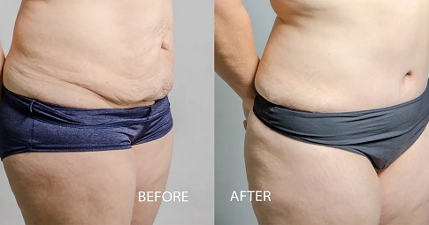 Laser Lipolysis Treatment before and after