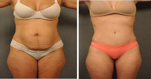 Laser Lipolysis Treatment before and after