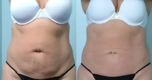 Laser Lipolysis Treatment before and after