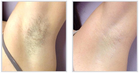 Laser hair bleaching before and after