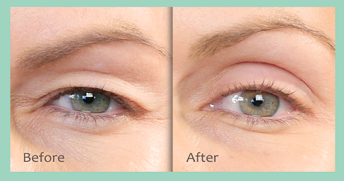 Plexr Plasma Eye Lift before and after