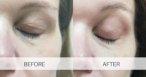 Plexr Plasma Eye Lift before and after